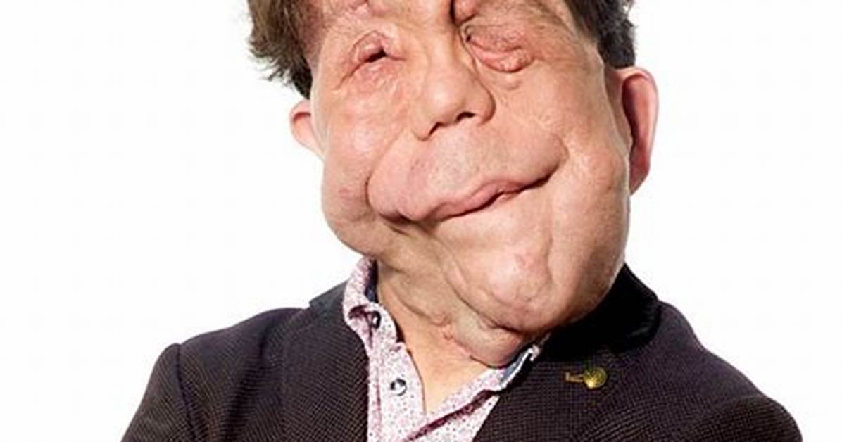 Exploring Adam Pearson's Relationships: a Journey Through Love and Connection