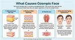 Exploring the Phenomenon of Ozempic Face: Causes, Effects, and Solutions
