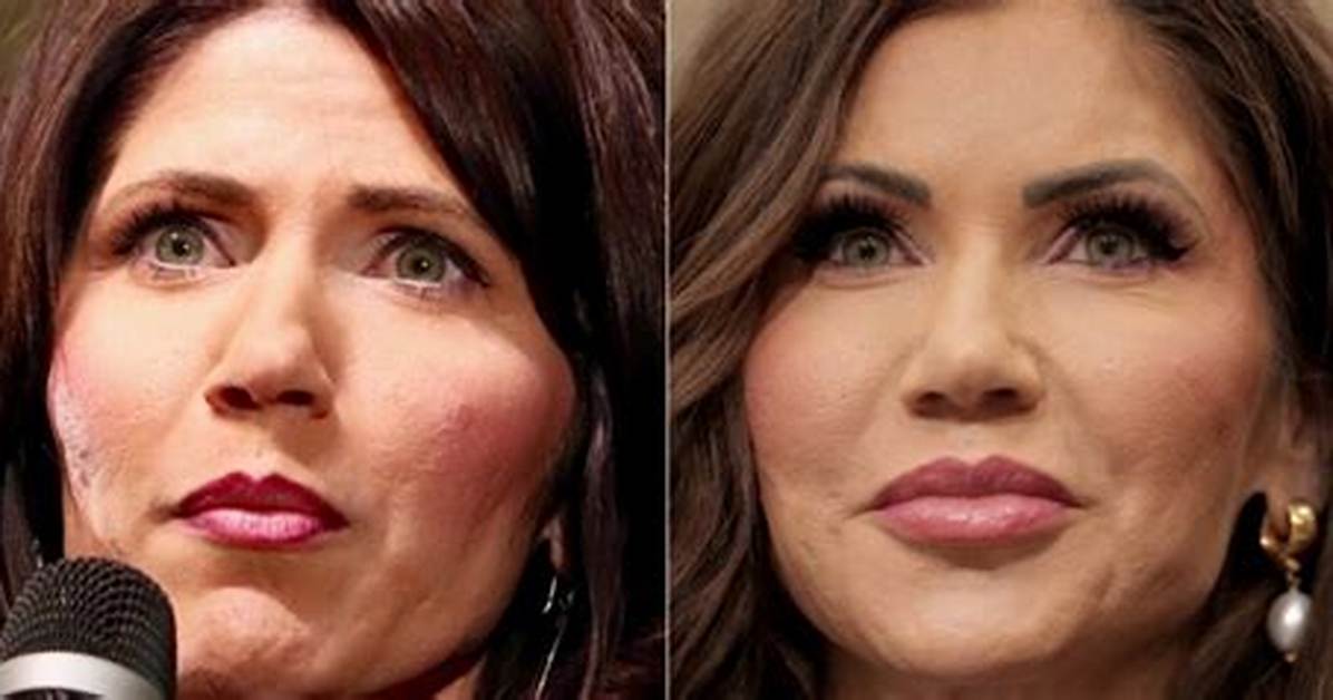 Kristi Noem Plastic Surgery: a Comprehensive Look