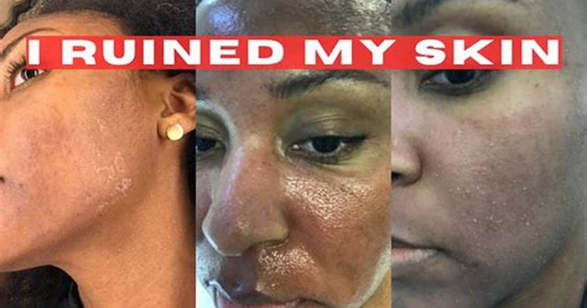 Microneedling Ruined My Skin: a Cautionary Tale