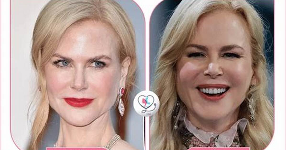 Nicole Kidman Facelift: a Comprehensive Look at Her Transformation