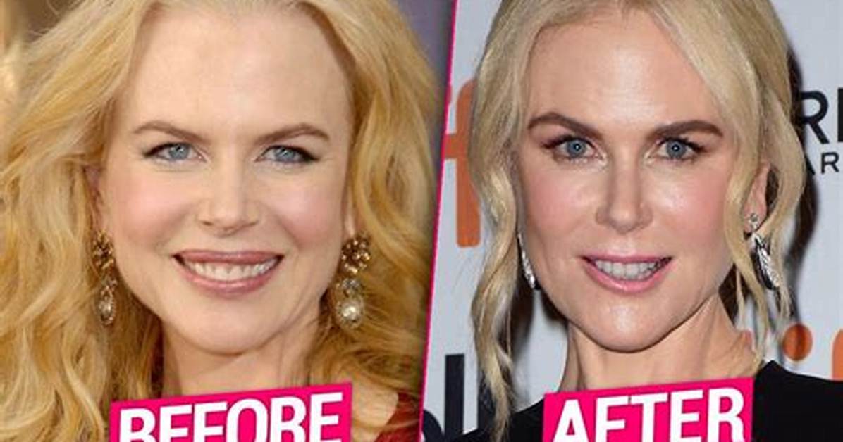 Nicole Kidman: the Facelift Journey of a Hollywood Icon