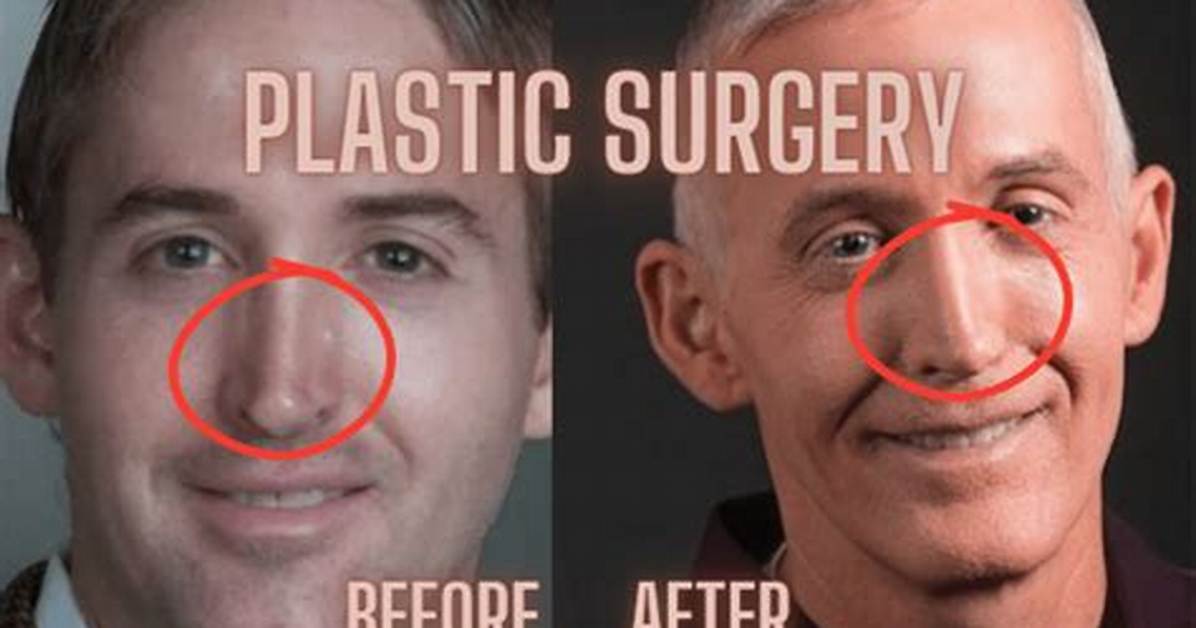 Trey Gowdy Nose Surgery: Understanding the Impact and Changes